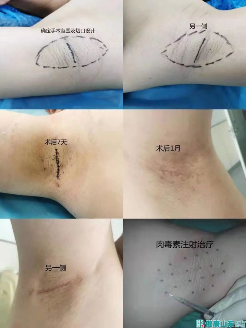 寻找最佳治疗狐臭方案
