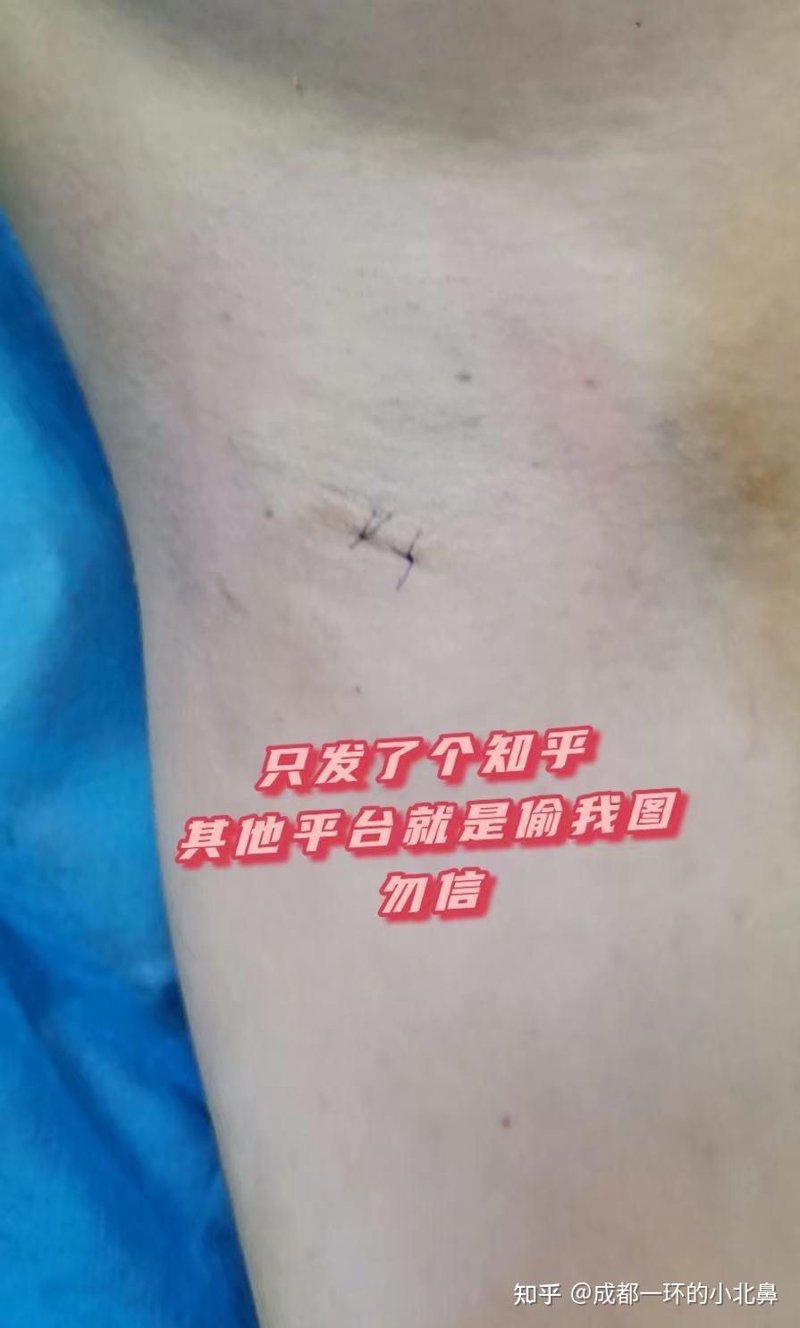 治疗狐臭哪家医院好