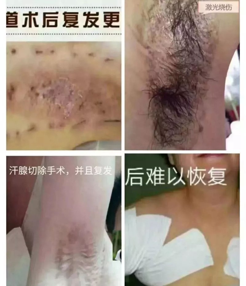 昆明昆大医院：腋臭困扰不再