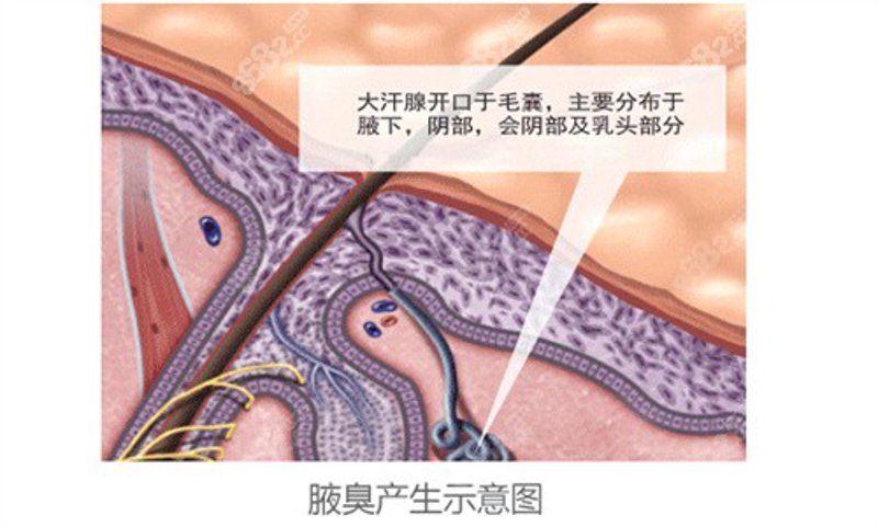 狐臭微创手术：悄然颠覆传统治疗方式