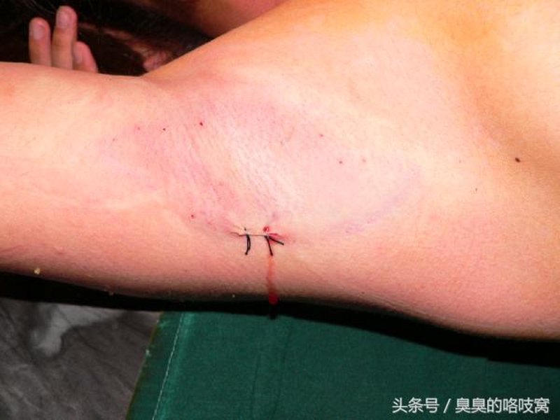 腋臭术后恢复