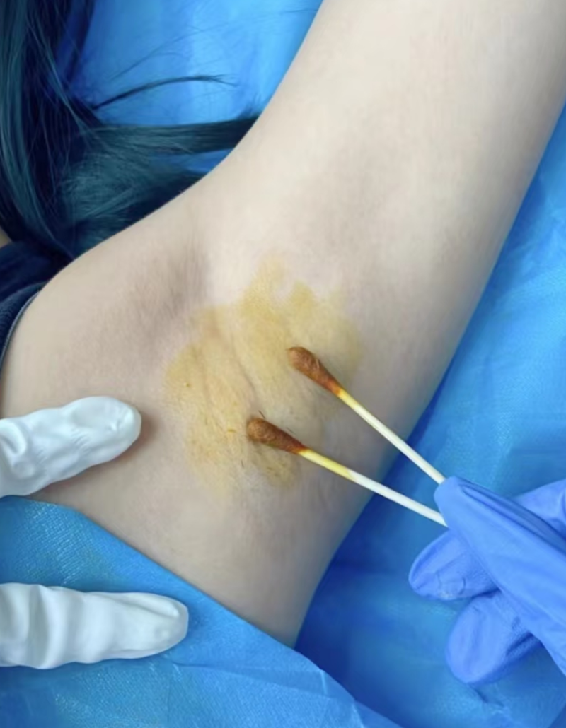 治疗狐臭哪家医院好
